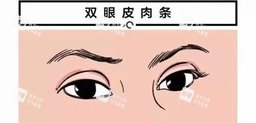 双眼皮肉条痕图.jpg