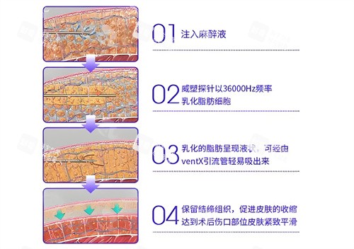 威塑吸脂手术步骤演示动画图.jpg 威塑吸脂手术步骤演示动画图.jpg