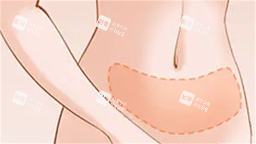 腹部吸脂成效展示图.png 腹部吸脂成效展示图.png