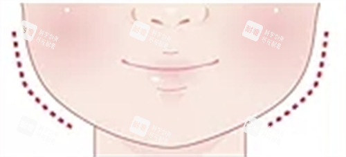 适合打玻尿酸面部轮廓.png