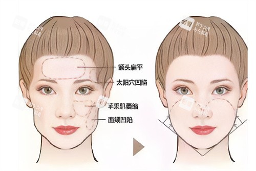 面部轮廓填充前后对比.jpg