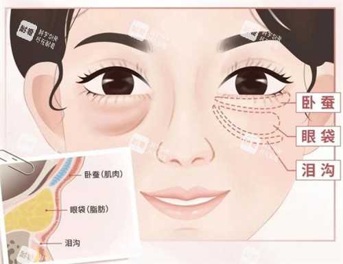 眼袋位置卡通图.jpg