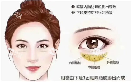 眼袋详细介绍动画图.jpg