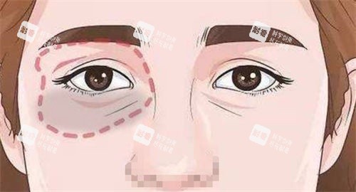 泪沟眼袋画线展示图.jpg