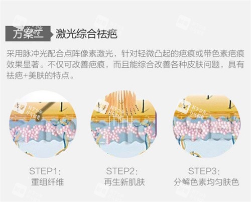 激光祛疤图示.jpg
