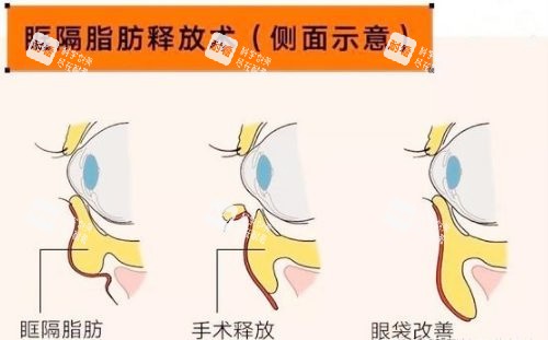 眶隔脂肪祛眼袋图示.jpg 眶隔脂肪祛眼袋图示.jpg