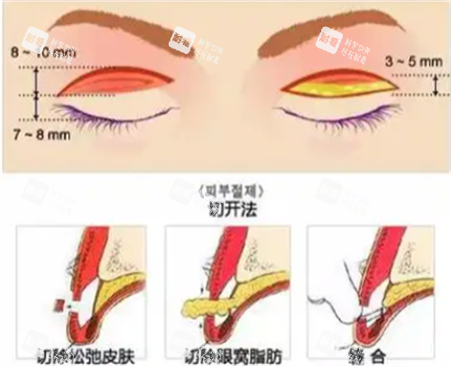 切开双眼皮手术.png 切开双眼皮手术.png