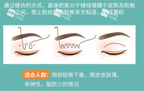 埋线双眼皮解析.jpg 埋线双眼皮解析.jpg