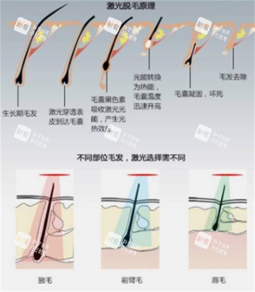 激光脱毛前后对比.jpg 激光脱毛前后对比.jpg