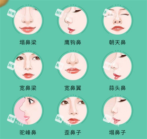 鼻部整形手术适应症.jpg 鼻部整形手术适应症.jpg