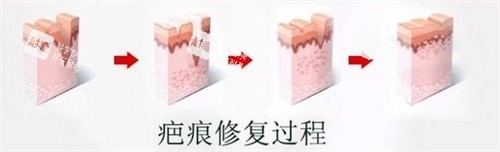 疤痕修复过程图.jpg