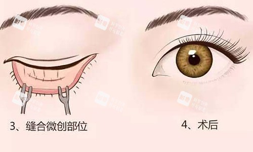 内切祛眼袋展示图.jpg