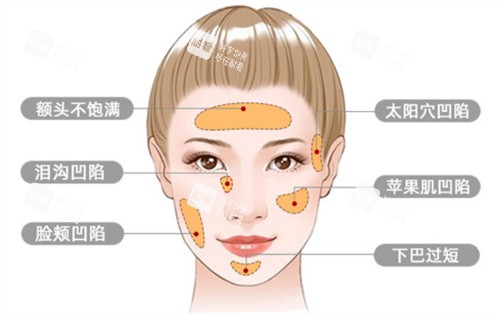 面部脂肪填充适应症.jpg 面部脂肪填充适应症.jpg