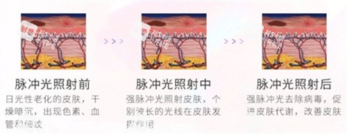 光子嫩肤对比.jpg