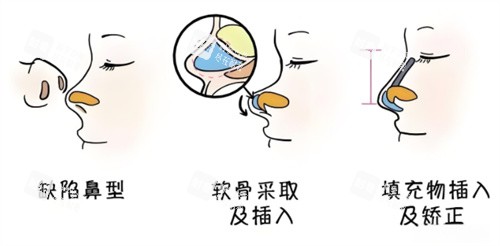 鼻综合手术过程动画.jpg