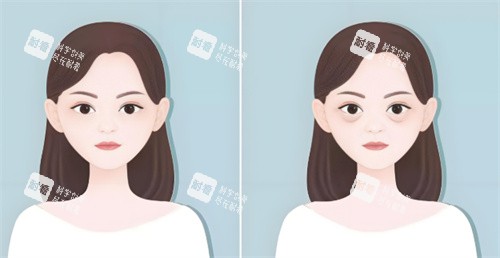 祛眼袋手术前后对比.jpg 祛眼袋手术前后对比.jpg