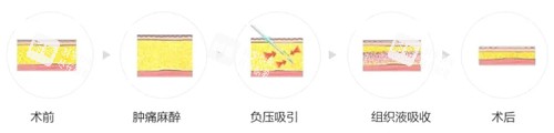 吸脂过程图解.jpg 吸脂过程图解.jpg