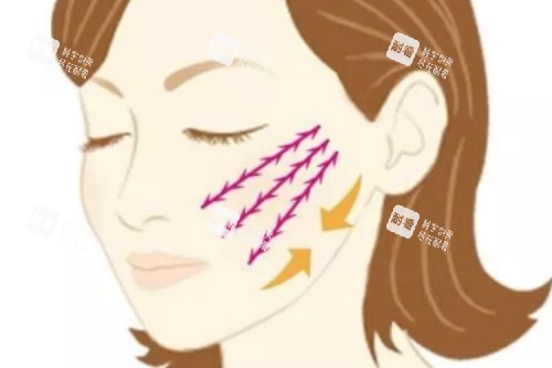 面部提升概念图.jpg 面部提升概念图.jpg