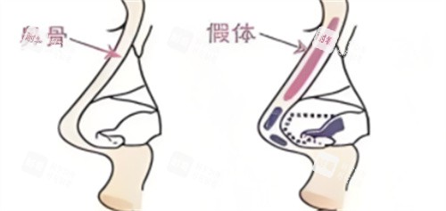 鼻综合假体植入.jpg 鼻综合假体植入.jpg