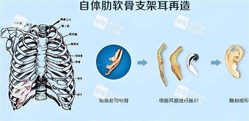肋软骨直埋耳再造术步骤演示图.jpg 肋软骨直埋耳再造术步骤演示图.jpg
