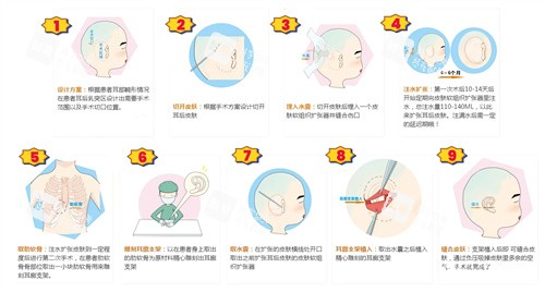 扩张器法耳再造手术动画演示图.jpg 扩张器法耳再造手术动画演示图.jpg