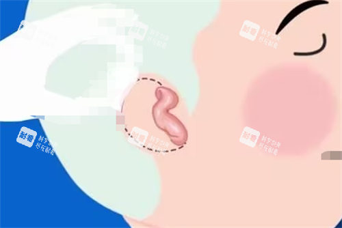 儿童耳再造耳畸形展示.png 儿童耳再造耳畸形展示.png