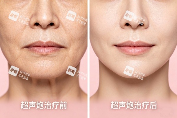 超声炮治疗前后对比图.jpg 超声炮治疗前后对比图.jpg
