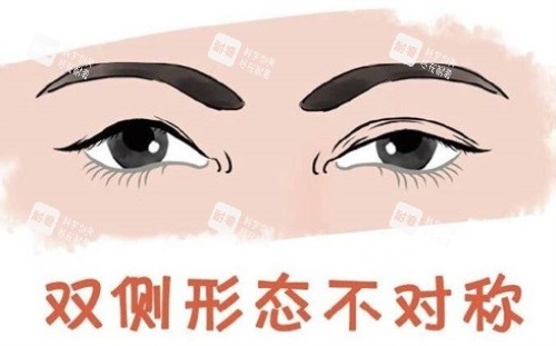 双眼皮形态不对称.JPG 双眼皮形态不对称.JPG