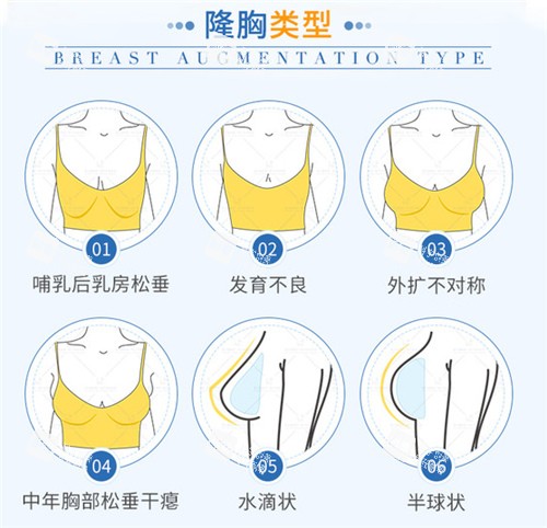 假体隆胸适应症.jpg 假体隆胸适应症.jpg