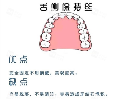 牙齿矫正舌侧保持器优缺点图.jpg