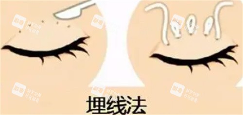 双眼皮埋线怎么做的.jpg 双眼皮埋线怎么做的.jpg