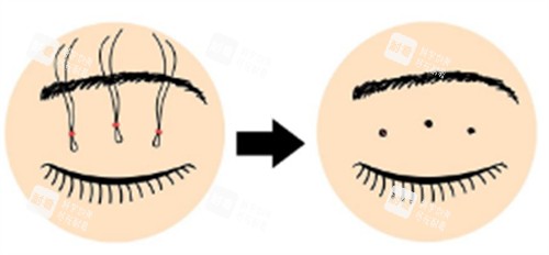 皮下速接双眼皮操作过程图解.jpg 皮下速接双眼皮操作过程图解.jpg