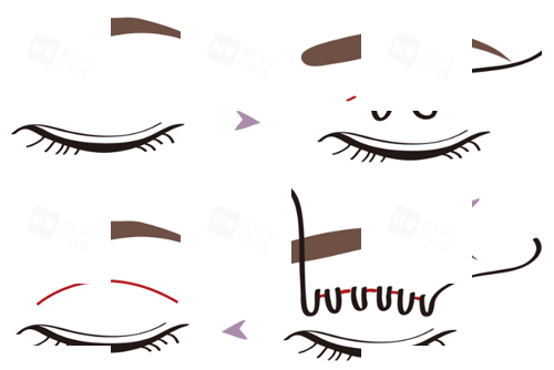 埋线双眼皮手术步骤图.png 埋线双眼皮手术步骤图.png
