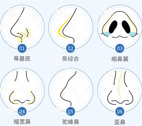 不同隆鼻技术图解.jpg