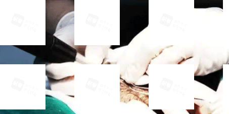 植发手术细节照片.gif