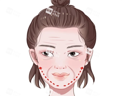 面部抗衰提升卡通图.jpg 面部抗衰提升卡通图.jpg