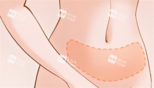 吸脂腹部区域.jpg