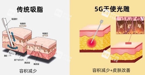 5G天使光雕对比传统吸脂.jpg