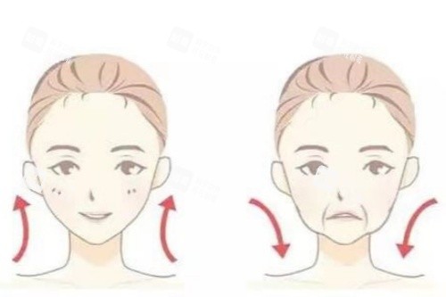 面部提升卡通对比图.jpg 面部提升卡通对比图.jpg