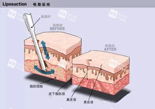 水动力吸脂手术原理动画图.jpg 水动力吸脂手术原理动画图.jpg