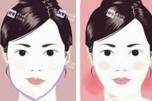 脸型不对称矫正前后对比图.jpg