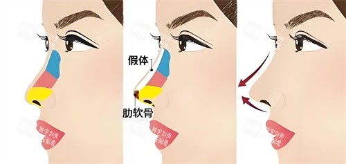 半肋骨隆鼻手术展示动画图.jpg 半肋骨隆鼻手术展示动画图.jpg