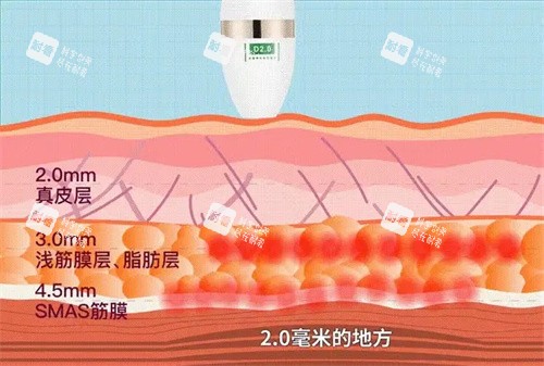 超声炮层次.jpg