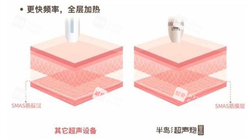 半岛超声炮和普通超声.jpg