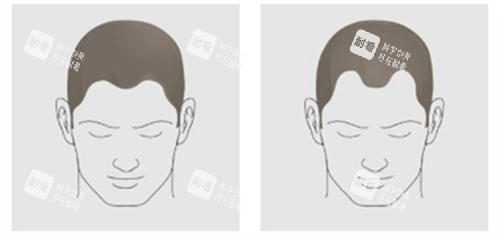 发际线对比.png