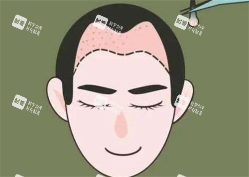 M型发际线种植.jpg