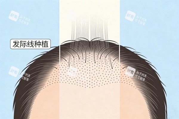 发际线种植卡通图展示.jpg