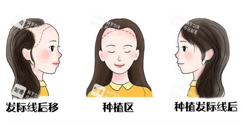 发际线后遗种植前后.jpg
