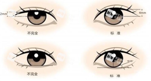 双眼皮示意图.JPG