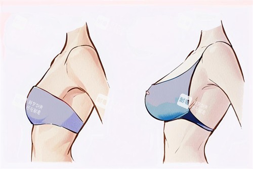 假体隆胸的前后对比图.jpg
